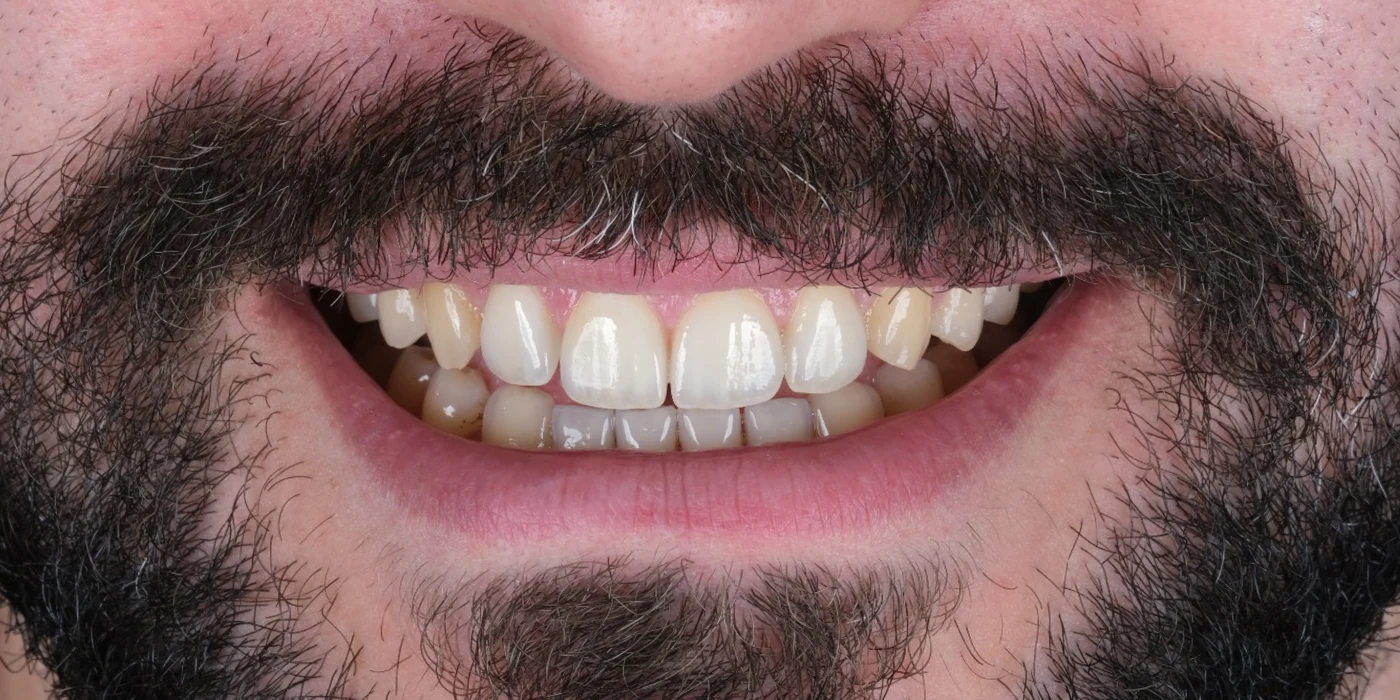 E.max-Keramikveneers: Nachher