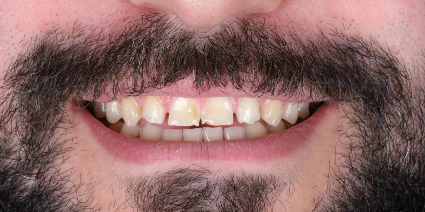 E.max-Keramikveneers: Vorher