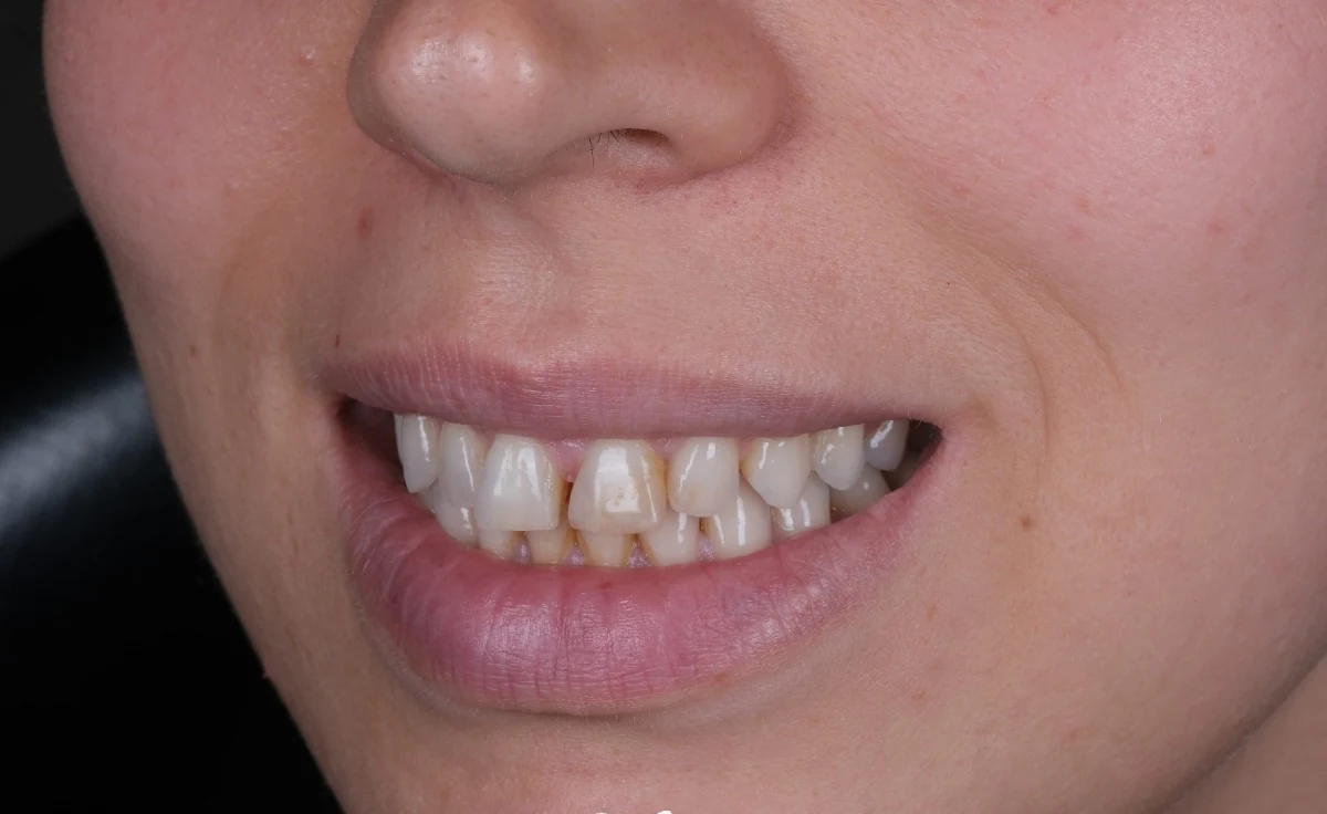 E.max-Keramikveneers: Vorher
