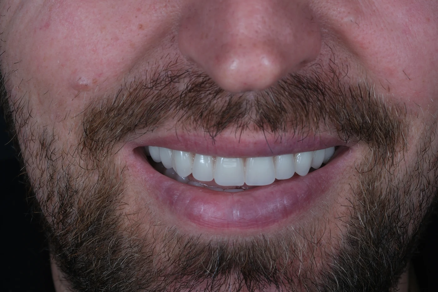 Implantatgetragene herausnehmbare Prothese: Nachher