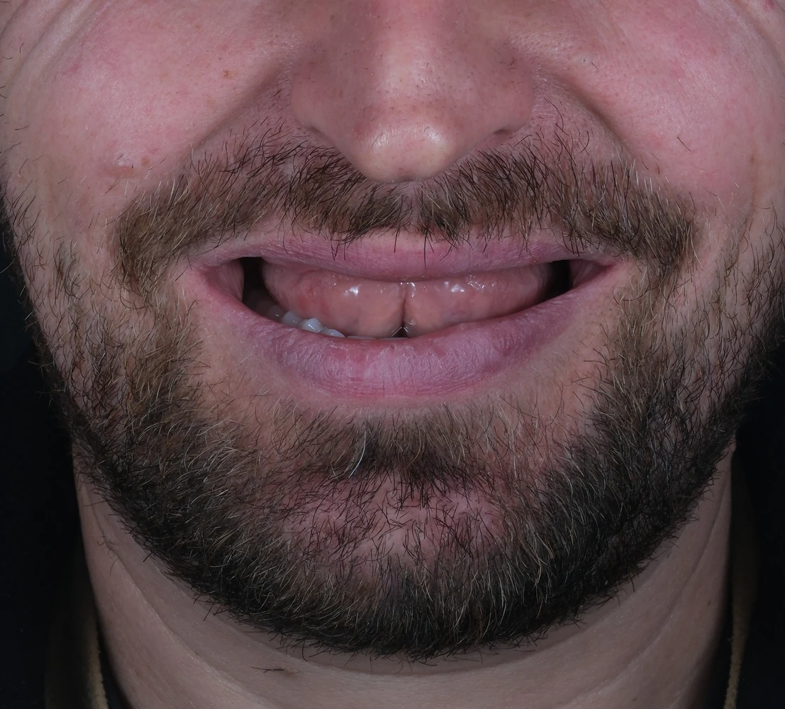 Implantatgetragene herausnehmbare Prothese: Vorher
