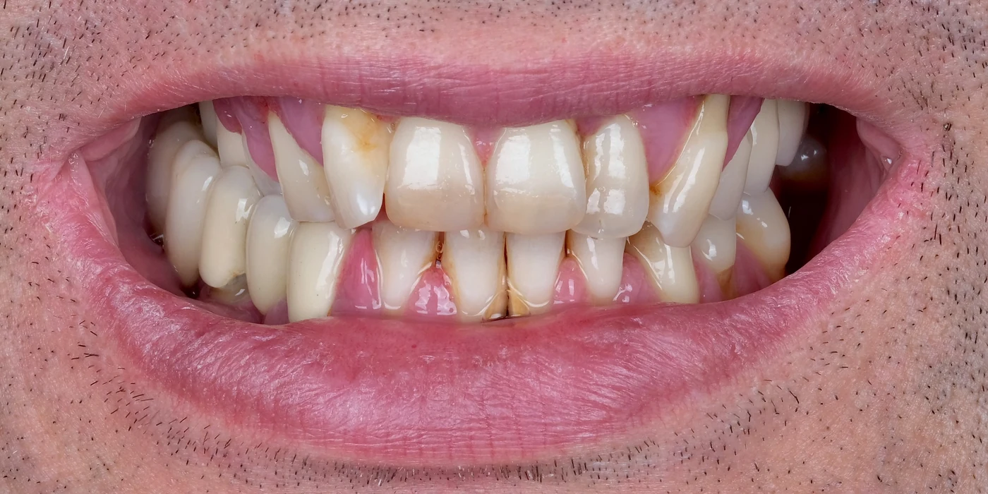 Implantatgetragener Zahnersatz aus Zirkon: Vorher