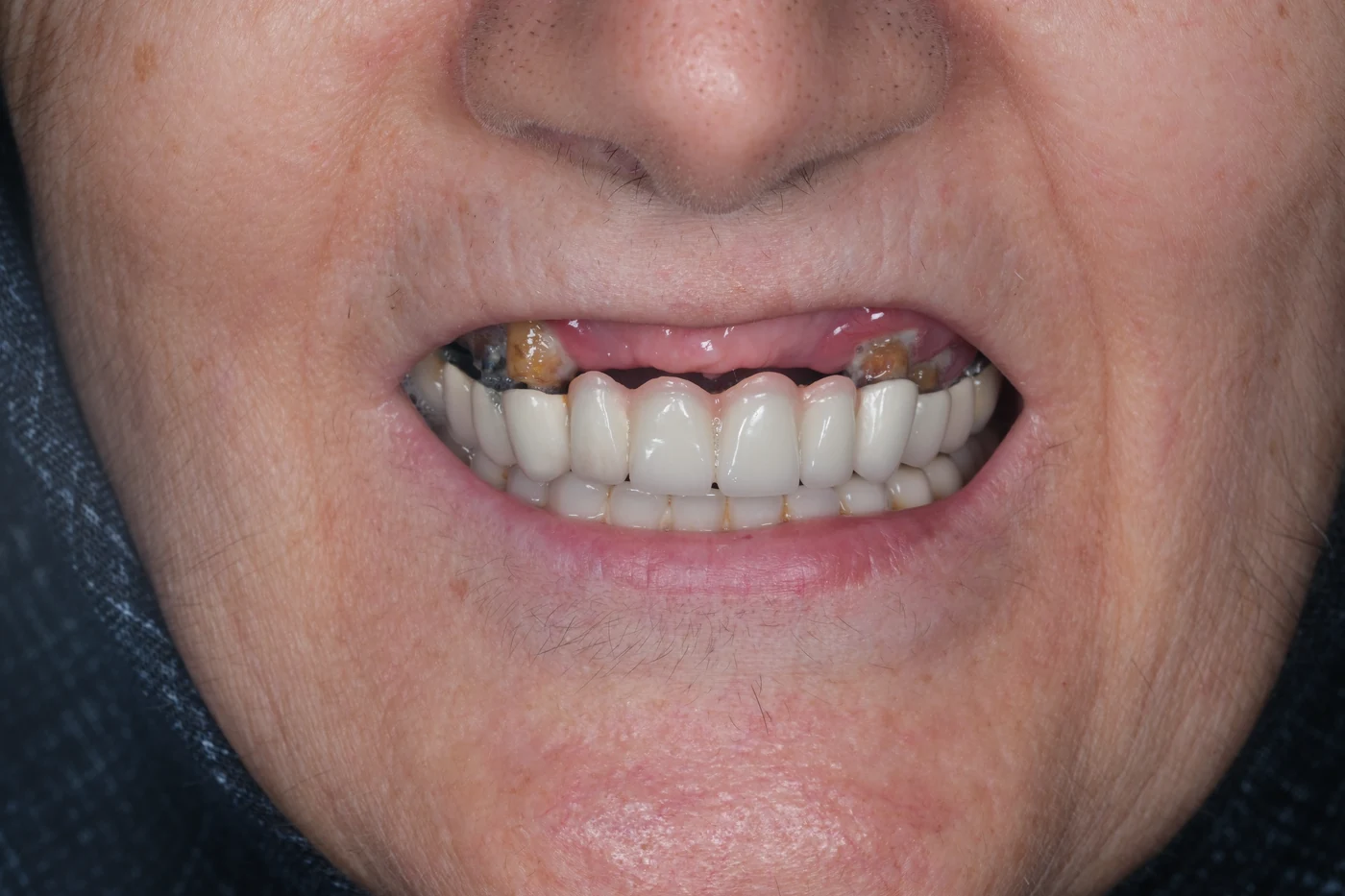 Implantatgetragener Zahnersatz aus Zirkon: Vorher