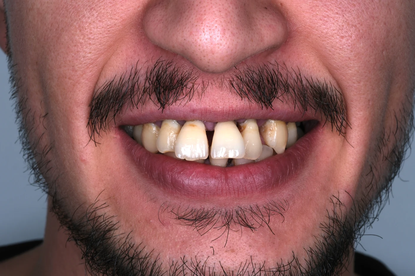Implantatgetragener Zahnersatz aus Zirkon: Vorher