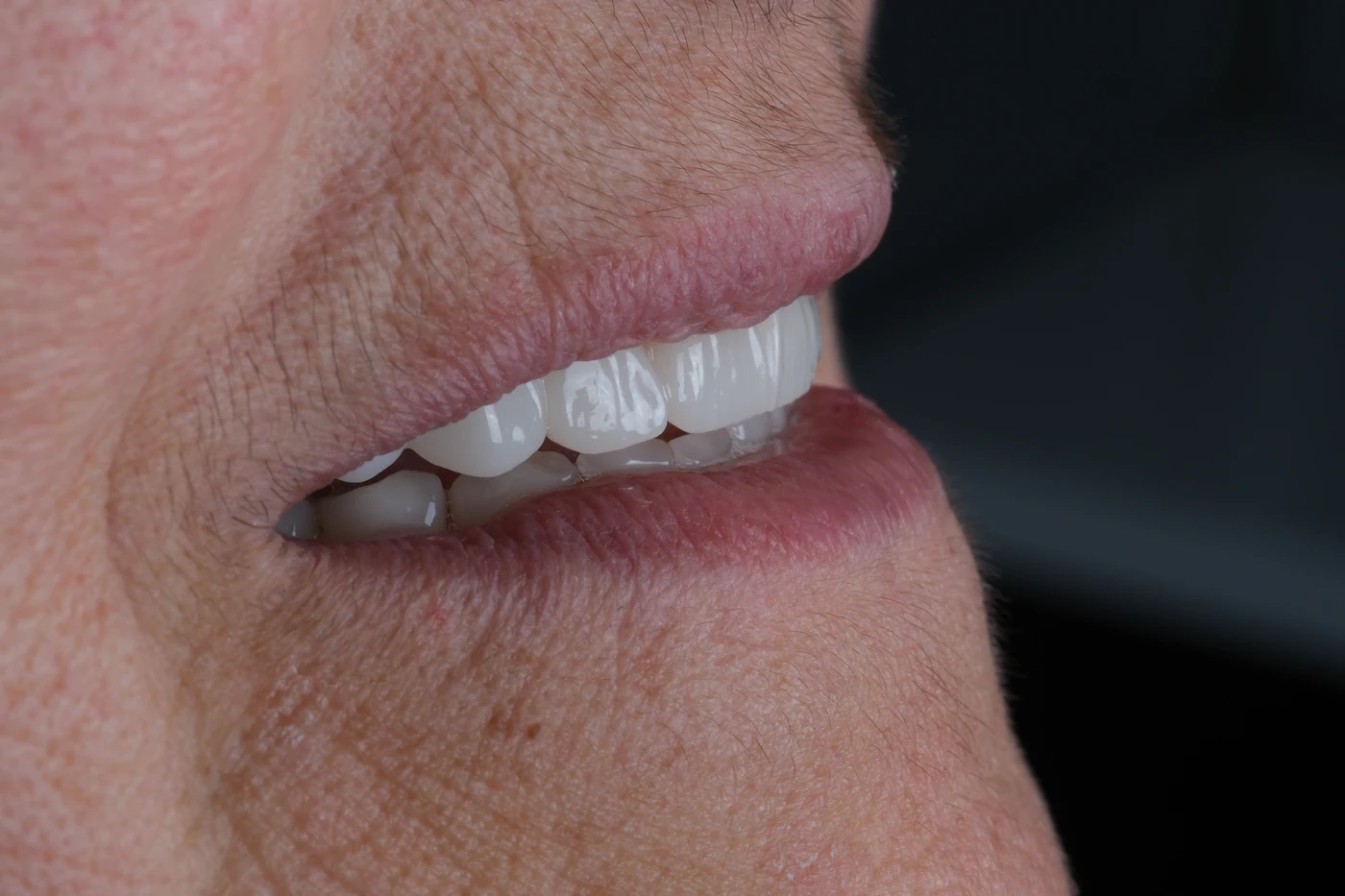 Implantatgetragener Zahnersatz aus Zirkon