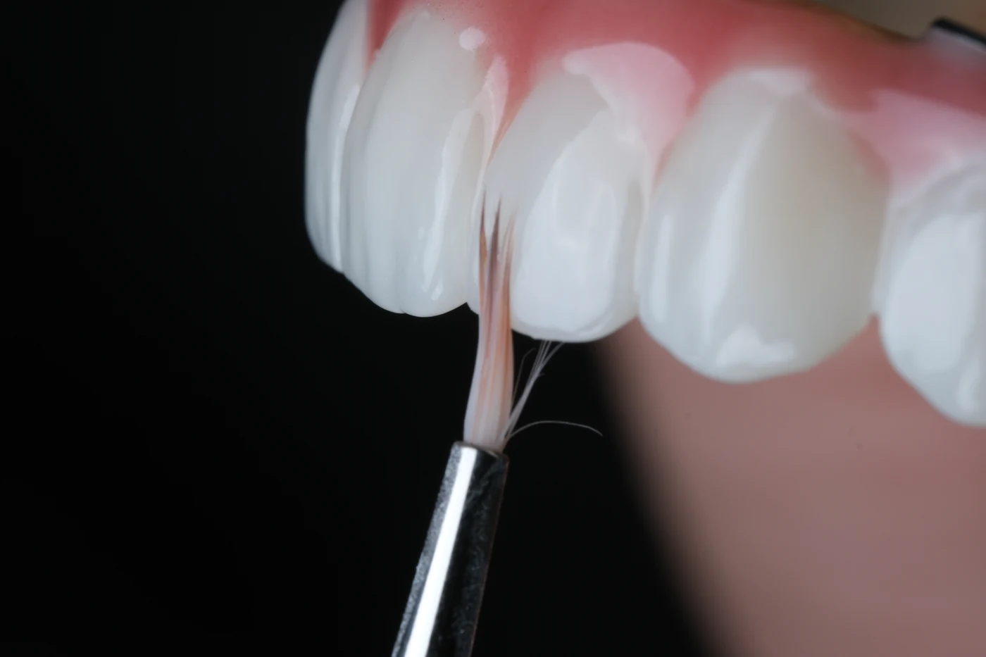 Implantatgetragener Zahnersatz aus Zirkon