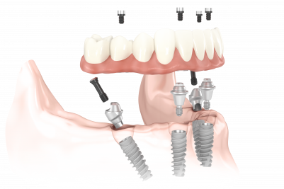 All On Four Implant